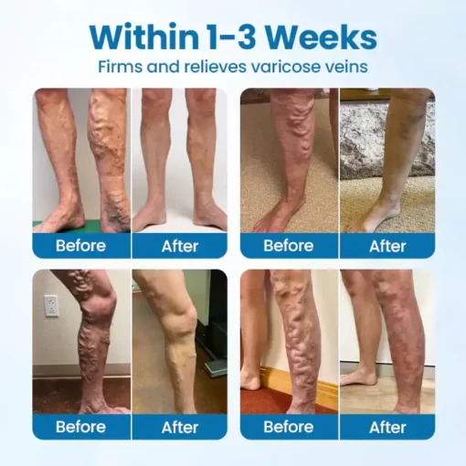 ADFIRE® VeinGuard Herbal Spray